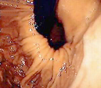 Endoskopische Aufnahme eines Zwerchfellbruchs (Hiatushernie) Endoskopische Aufnahme eines Zwerchfellbruchs (Hiatushernie)
